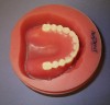 Figure 2: Avadent’s milled, monolithic one-piece denture.