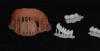 Figure 5:  In-office 3D printed denture base and teeth.