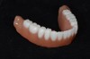 Figure 6: Teeth and denture based bonded together.