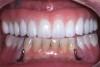 The patient and dentist were unhappy with the typical screw-retained zirconia restoration after delivery (Prettau Zirconia).