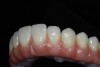 Same product but a different outcome with the monolithic full-contour zirconia screw-retained bridge (Prettau Zirconia).