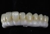 The screw-retained zirconia (Prettau Zirconia) implant framework after sintering.