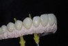 View of the screw-retained monolithic implant bridge with pink ceramic application.