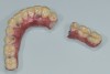 View of a broken full-contour zirconia restoration that resulted from not following the required processing protocols.