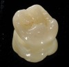 View of a highly esthetic monolithic IPS e.max lithium disilicate crown after staining and glazing.