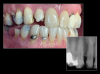 Fig 13. COCO Lux is used here for emergency treatment, blunt force trauma to the right lateral incisor.