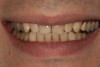 Fig 1. Preoperative smile photograph.
