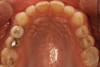 Fig 4. Preoperative occlusal view of upper arch.
