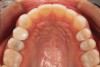 Fig 13. Postoperative upper anterior view and occlusal views of the upper and lower arches.