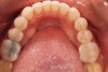 Fig 14. Digital smile design software enables parameters of interim prosthesis to be facially generated; (Fig 12) front view, (Fig 13) occlusal view, (Fig 14) 12 o’clock view.