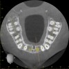 Fig 2. CBCT images show axial (Fig 2) and cross-sectional (Fig 3) views, and 3D reconstruction view (Fig 4) with virtually planned implant Nos. 8 and 9.