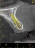 Fig 3. CBCT images show axial (Fig 2) and cross-sectional (Fig 3) views, and 3D reconstruction view (Fig 4) with virtually planned implant Nos. 8 and 9.