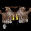 Fig 4. CBCT images show axial (Fig 2) and cross-sectional (Fig 3) views, and 3D reconstruction view (Fig 4) with virtually planned implant Nos. 8 and 9.