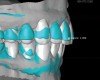 Fig 8. Scans are used to mock-up desired restorative results using modeling software. The teal-green areas represent the current tooth form, and the white areas show the desired or digital wax-up. A reduction of 1.009 mm was required prior to preparation, making endodontic treatment likely if orthodontic treatment is not considered.