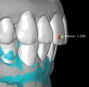 Fig 9. Scans are used to mock-up desired restorative results using modeling software. The teal-green areas represent the current tooth form, and the white areas show the desired or digital wax-up. A reduction of 1.009 mm was required prior to preparation, making endodontic treatment likely if orthodontic treatment is not considered.