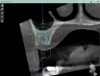 Fig 12. Virtual planning of a posterior implant (Fig 12) resulted in inadequate restorative running room for the crown emergence profile in the cross-sectional CBCT image. Revision (Fig 13) resulted in deeper positioning of the implant for restorative running room but necessitated transcrestal sinus elevation, possibly with the addition of bone via the osteotomy to tent the membrane.