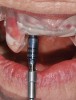 Fig 15. The printed static guide is used to precisely control preparation of osteotomy (Fig 14) and delivery of the implant through the guide (Fig 15).