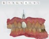 Fig 16. Presurgical design and fabrication of restorative components based on virtual implant position allow for possible minor angle/linear deviations (Fig 16 through Fig 18). Component options are broad and may include a custom healing abutment and bondable polymethyl methacrylate restoration; a single restoration with an engaging or non-engaging base; provisional fixed partial dentures (Fig 19), which can be indexed intraorally to prepared temporary abutments; or a full-arch restoration to be indexed intraorally to prepared temporary abutments.