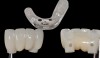 Fig 19. Presurgical design and fabrication of restorative components based on virtual implant position allow for possible minor angle/linear deviations (Fig 16 through Fig 18). Component options are broad and may include a custom healing abutment and bondable polymethyl methacrylate restoration; a single restoration with an engaging or non-engaging base; provisional fixed partial dentures (Fig 19), which can be indexed intraorally to prepared temporary abutments; or a full-arch restoration to be indexed intraorally to prepared temporary abutments.