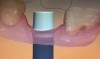 Fig 20. This is an example of poor design of the abutment base in the transmucosal region.