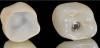 Fig 23. Full-contour monolithic crowns for teeth and implants constitute the last phase of the digital workflow.