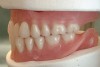 Fig 6. Balanced articulation in protrusion of the mandible: right side (Fig 5) and left side (Fig 6).