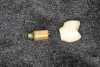 Fig 4. Two-piece, screw-retained implant crown and abutment. The crown is cemented to the abutment outside of the mouth.