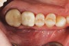 Fig 5. Occlusal view of a screw-retained crown. The screw head has been blocked and the access hole sealed with composite resin.