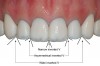 Fig 4. Interincisal angles: A narrow inverted “V” forms between the two central incisors; asymmetrical inverted “V”s form between the central and lateral incisors; and wide inverted “V”s form between the
lateral incisors and canines.