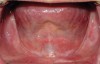 Fig 9. Mandibular arch with shallow vestibular and floor-of-the-mouth depth.