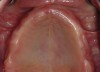 Fig 5. Maxillary arch with shallow palatal vault but adequate vestibular depth.