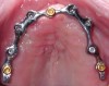 Fig 6. Ovoid arch form with 6 implants placed and connected with a bar, which was selected due to the shallow palate and vestibule.