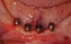 Fig 13. Mini implants with attachments in the mandible with minimal vestibular depth but adequate depth of the floor of the mouth.