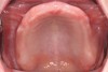 Fig 3. Maxillary arch with good vestibular and palatal depth.