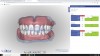 Figure 3: Screen capture of a frontal view taken from digital denture design software.