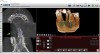 Figure 5: Screen capture shows the exported virtual implant plan ready for dynamic navigation surgery.