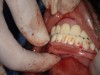 Figure 11: It is important to ensure the conversion denture can align with the opposing dentition using the occlusal locks prior to pick-up.