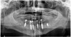 Figure 13: The left posterior implant had low primary stability and was elected not to be connected to the conversion prosthesis, as shown in the post-operative panoramic radiograph.