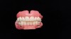 Figure 7: Frontal view of the same monolithic conversion denture is shown with complementary maxillary monolithic immediate complete denture.