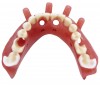 Figure 19: Both maxillary and mandibular SurgiDentures in static occlusion feature occlusal locks, which are also seen in the occlusal view of the mandibular SurgiDenture.