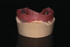Fig 17. A wax matrix is formed to contain the gypsum material at the proximal, gingival, buccal, and lingual aspects.