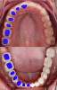 Fig 1. The cross-sections of various teeth, as identified by the blue markings, demonstrate the different shapes of soft-tissue profile needed at the implant platform to replicate a natural tooth emergence profile.