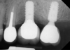 Fig 4. Comparison of implant placement depths, which are dependent on the implant design: a tissue-level implant is shown replacing the maxillary first molar, and a deeper placement depth using an implant system with a platform-switching feature is shown replacing the second molar.