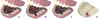 Fig 7. Custom abutment created to develop the soft tissue for emergence profile: (A) the resulting soft-tissue emergence profile, (B) a custom open-tray impression head inserted, and (C) the replication of the emergence profile in the resulting soft-tissue model created from the (D) impression.