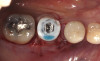 Fig 8. A custom healing abutment was created to replicate the emergence profile for a mandibular molar, which is square in cross-section.