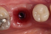 Fig 9. After removal of the custom healing abutment, a natural-appearing emergence profile for a mandibular molar, square in cross-section, was evident.