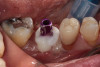 Fig 10. A custom impression abutment would allow communication of the emergence profile that was developed with the customized healing abutment.