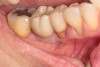 Fig 11. Final implant restoration replicating the emergence profile of the mandibular molar it replaced.