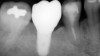 Fig 12. Radiograph of the final restoration demonstrating a natural emergence profile of the tooth that was replaced.