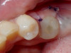 Fig 13. A custom healing abutment was created to replicate the emergence profile for a mandibular molar, which is square in cross-section.